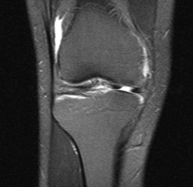 Menisküs Yırtığı: Belirtiler, Tanı ve Kişiye Özel Tedavi Yaklaşımı